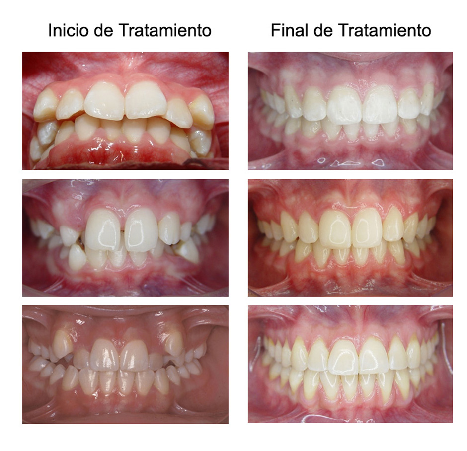 Tratamiento de ortodoncia correctiva